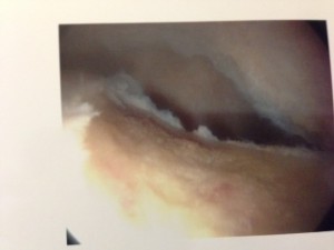 Labrum tear across the Acetabulum after inflammation removal